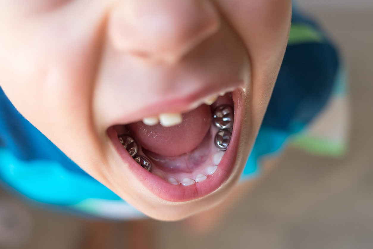 pediatric dental crowns